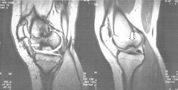 Röntgenaufnahme einer Osteochondrosis dissecans im Kniegelenk