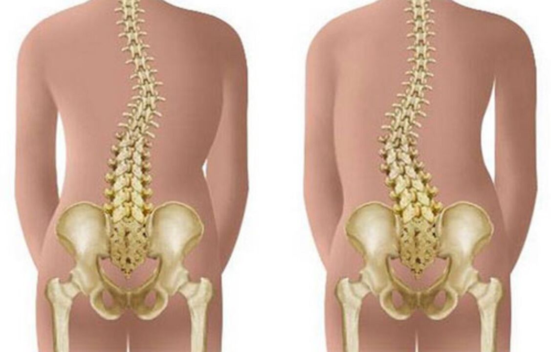 Skoliose als Ursache für Rückenschmerzen im Bereich der Schulterblätter