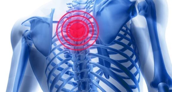 Behandlung der Osteochondrose der Brustwirbelsäule