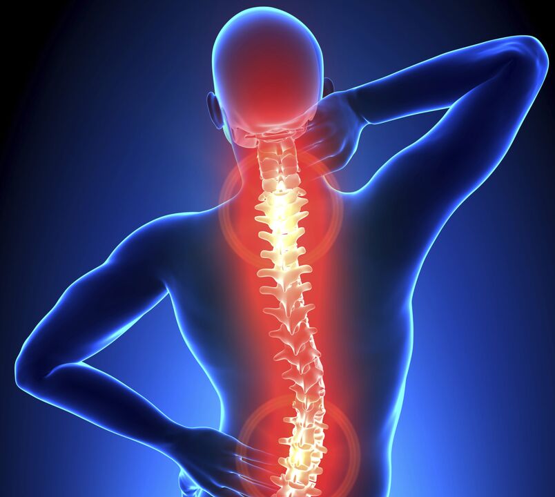 Osteochondrose der Wirbelsäule