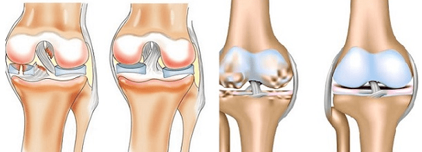 Arthritis und Arthrose